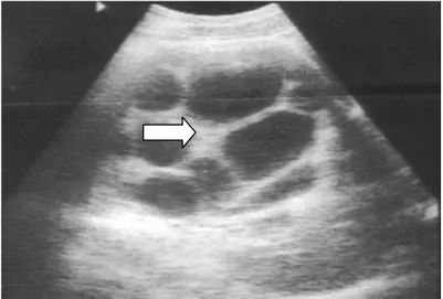 Figure 3: une échographie abdominale objectivant un KHR droit type III. 