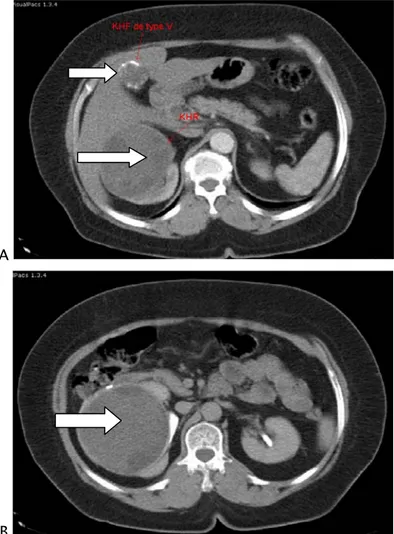 Figure 4 : Patiente âgée de 40 ans, présentant des  douleurs lombaires chroniques et hydaturie  dans un contexte d’apyrexie