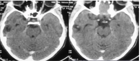 Figure 24 : IRM coupe axiale montrant une otite moyenne cholestéatomateuse   droite compliquée d’une suppuration intracranienne 