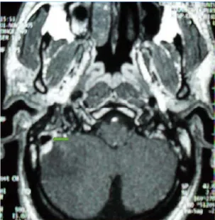Figure 26 : IRM coupe axiale T1 + Gado : thrombose du sinus latéral droit 