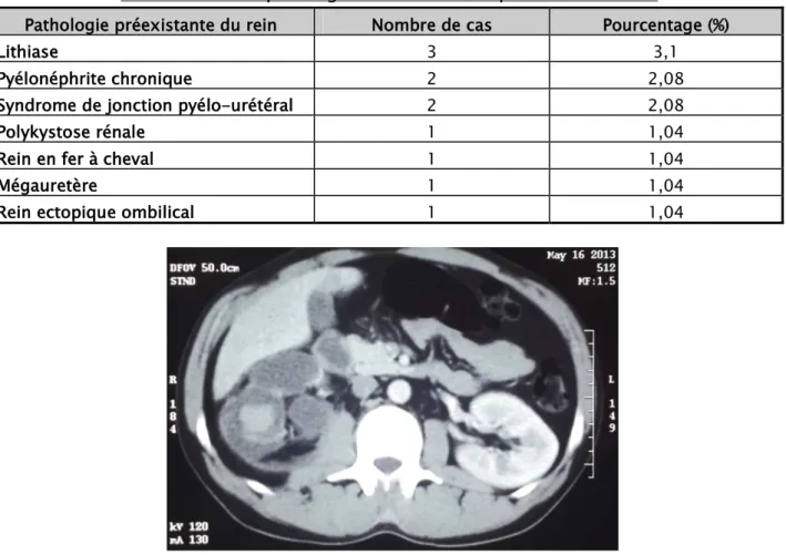 Tableau N°IV : les pathologies du rein révélées par un traumatisme 