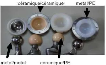 Figure 8 : Différents couples de frottement utilisées   en chirurgie prothétique de la hanche 