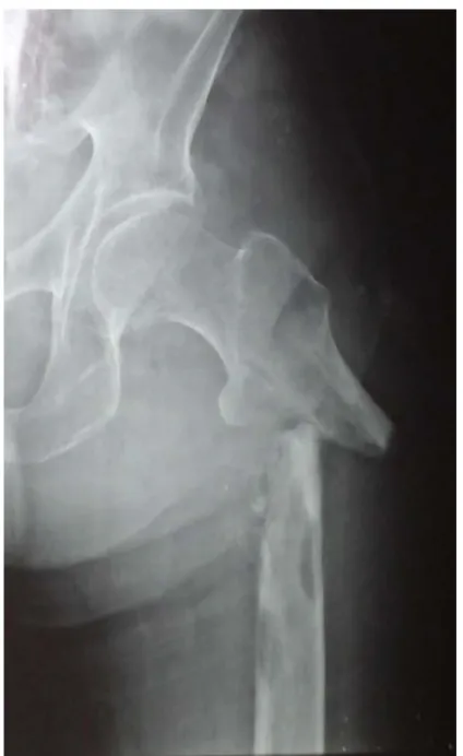 Figure 12:fracture sous trochantérienne du fémur gauche sur os pathologique   chez un patient de 61 ans 