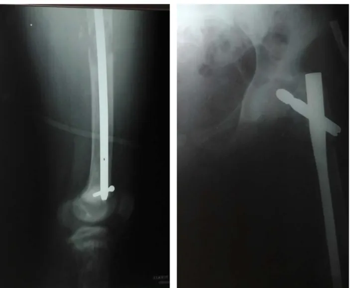 Figure 14 :double fracture sous trochantérienne et diaphysaire du fémur droit   chez un patient de 19 ans ? traité par clou gamma long