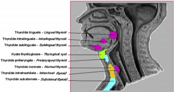 figure 7: situations ectopiques de la thyroide 