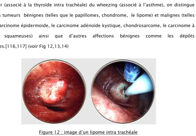 Figure 12 : image d’un lipome intra trachéale                     