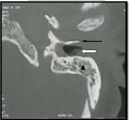 Figure 9 : TDM du rocher gauche en coupe axiale en fenêtre osseuse objectivant: un comblement  du CAE (flèche blanche), une lyse de l’os tympanal (flèche noire) avec comblement des cellules 