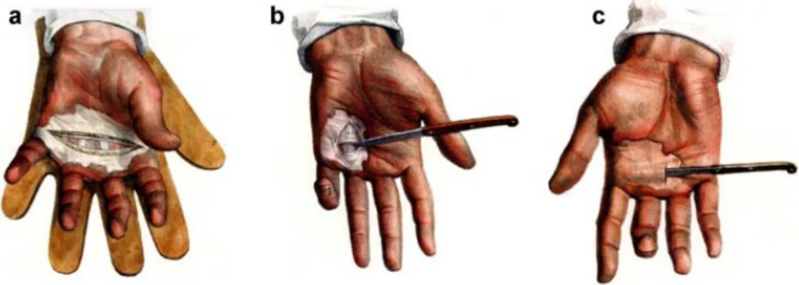Figure 9 : Techniques utilisées vers 1835 :Dupuytren ;Cooper ;Goyrand.[298] 