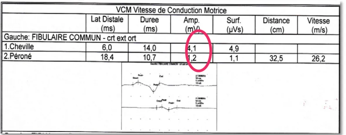 Figure 5: ENMG de la conduction motrice du nerf Fibulaire commun gauche objectivant un  Bloc  de conduction de 30%