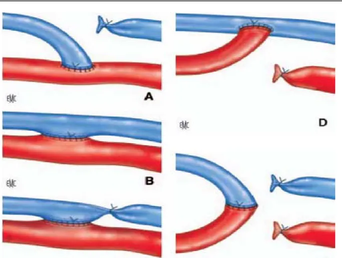 Figure 8 : Variantes anastomotiques d’une fistule radiale  A. Anastomose latéro-terminale de la veine sur l’artère  B