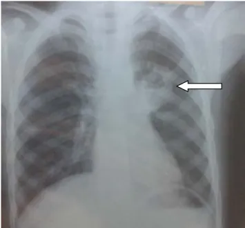 Figure 9 : Radiographie thoracique de face objectivant une image cavitaire à paroi épaisse  siégeant au niveau parahilaire gauche en rapport avec un KHP