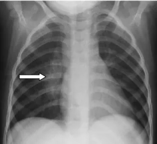 Figure 11: Radiographie thoracique de face montrant des adénopathies hilaires droites d’origine  tuberculeuse