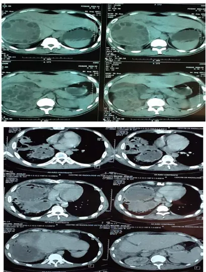 Figure 12 « suite » : TDM thoraco-abdominale   mentrant un KH suppuré et fistulisé dans la cavité pleurale 