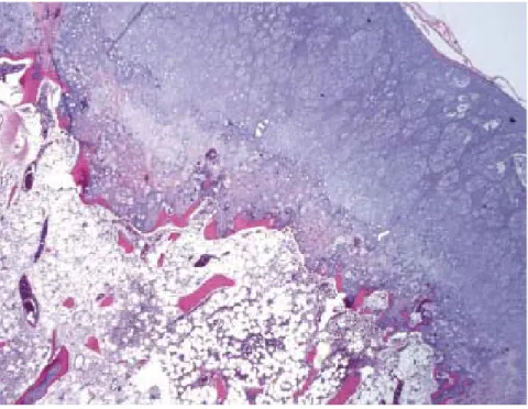 Figure 2 : Image microscopique d’un ostéochondrome montrant une coiffe de cartilage hyalin  surmontant un tissu osseux trabéculaire, avec ossification enchondrale
