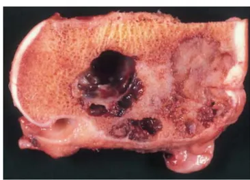 Figure 5 : Aspect macroscopique d’un chondroblastome du fémur distal montrant une zone  charnue blanchâtre, il s’y associe un foyer kystique anévrismal secondaire [9]