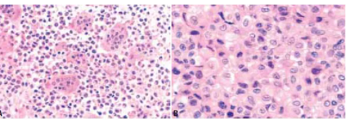 Figure 6: A: Chondroblastome présentant des feuillets de chondroblastes d'apparence uniforme  et de nombreuses cellules géantes de type ostéoclastique aléatoirement distribués