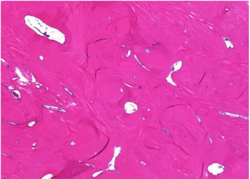 Figure 8 : Image microscopique d’un ostéome montrant une matrice osseuse dense avec de rares  éléments médullaires