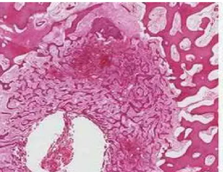 Figure 10: Image microscopique du nidus d’un ostéome ostéoïde qui est   bien différencié de l’os sclérotique