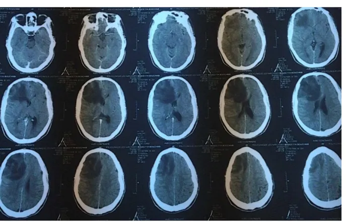 Figure 6: TDM cérébrale en coupe axiale chez un patient de 22 ans révélant une lésion  hypodense, frontale droite ne prenant pas le contraste