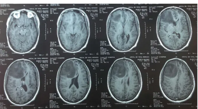 Figure 7: IRM cérébrale en coupe axiale et en séquence pondérée T1 avec injection de  Gadolinium chez un patient de 22 ans, objectivant un processus frontal droit en hyposignal 