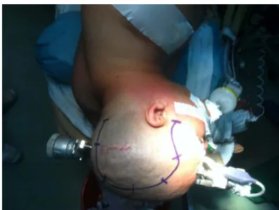 Figure 8 : Position en décubitus latéral droit du patient avec fixation de la tête par têtière de  Mayfield, et tracé de l’incision
