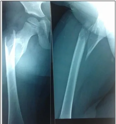 Figure 6 : Radiographie standard : fracture du fémur chez une fille de 4 ans   sur kyste osseux simple : image lacunaire, radiotransparente, bien limitée,  
