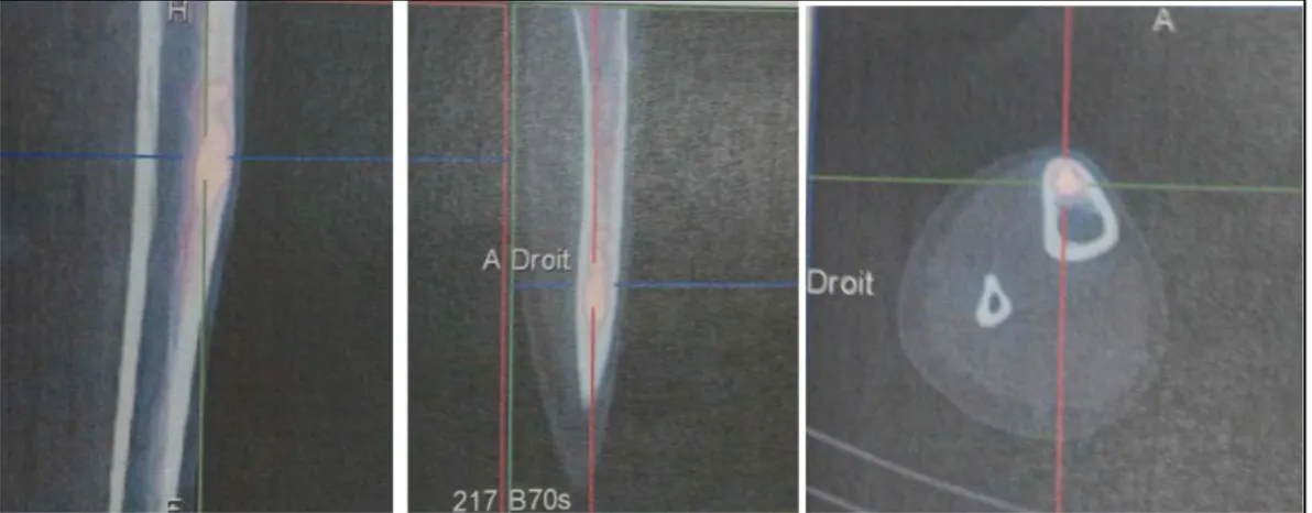 Figure 13 : Coupes tomoscintigraphiques couplées au scanner centré sur tibia (SPECT/CT):  fixation modérée du traceur correspondant à une image de nidus.