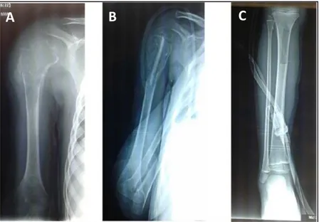 Figure 16 : Radiographie standard: Fracture de l’humérus chez un enfant de 5 ans sur  kyste osseux anévrysmal
