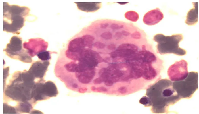 Figure 5 :  Mégacaryocyte (Laboratoire d’Hématologie HMA) 