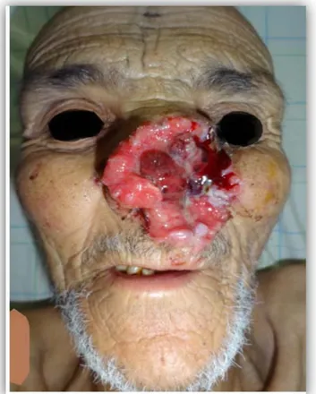 Figure 14 : aspect ulcérobourgeonnant d’un carcinome épidermoïde centrofacial   chez un patient âgé de 88 ans remontant à 6 ans