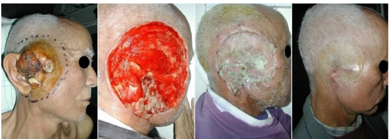 Figure 31 : Greffe de peau totale après exérèse tumorale   d’un carcinome basocellulaire avec auriculoctomie