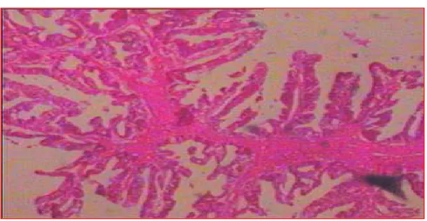 Figure 11 : Adénocarcinome papillaire de la vésicule biliaire                     [Iconographie du service d’anatomie pathologique CHU-Fès] 