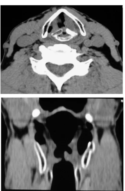 Figure 11: coupe axiale et coronale : processus tumoral de la corde vocale gauche   avec aspect condensé de l’aryténoide homolatéral 