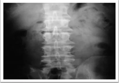 Figure 4: Radiographie standard  de face du rachis  lombo-sacré montrant des signes  d’arthrose lombaire étagée 