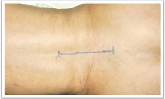 Figure 11: Tracé de l’incision cutanée médiane postérieure centrée selon les étages ciblés