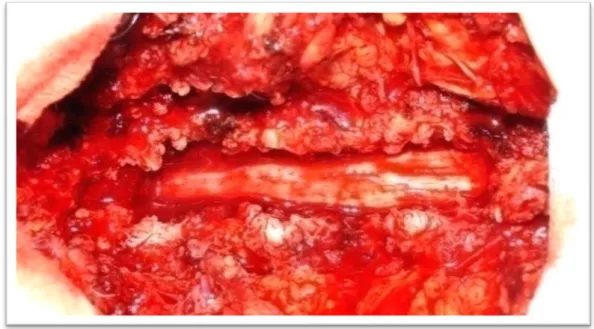 Figure 13 : Vue opératoire après  une laminectomie  lombaire réalisée sur trois niveaux