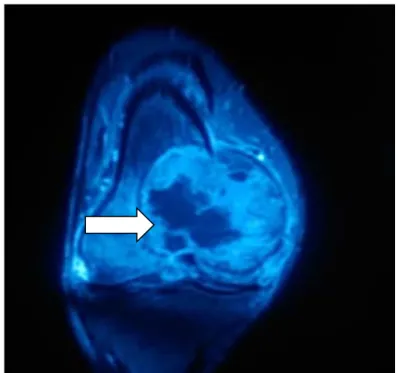 Figure  24: Processus lésionnel épiphyso-métaphysaire distale du fémur   avec envahissement du genou et les PM