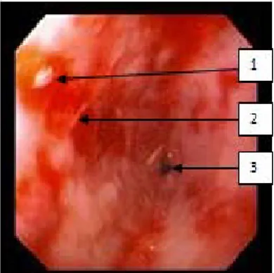 Figure  9: Sténose peptique serrée avec lésions  d’œsophagite sévère. 1-  Muqueuse œsophagienne