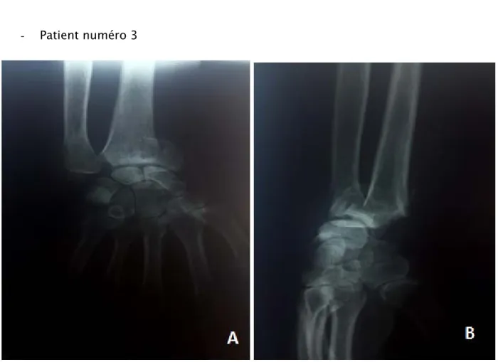 Fig. 12 : radiographie pré opératoire d fracture extra articulaire de l’extrémité inferieure de  radius 