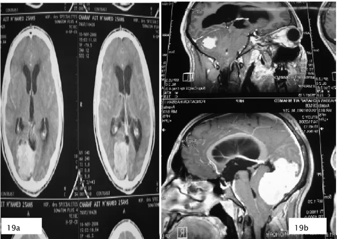 Figure 7a : TDM cérébrale en coupe axiale après injection du PDC montrant la portion  Sustentorielle d’un méningiome sus et sous tentoriel