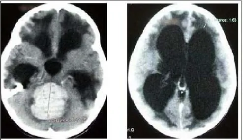 Figure 13: TDM cérébrale : Coupes axiales objectivant une hydrocéphalie tri-ventriculaire sur  épendymome étendu du 4 ème  ventricule 