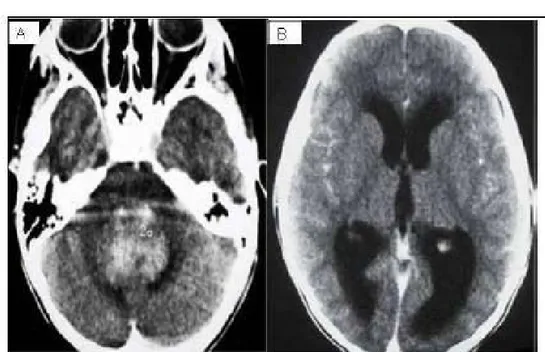 Figure 14  :  TDM cérébrale : coupes axiales sous tentorielle (A) et sus tentorielle (B) montrant  une Hydrocéphalie tri-ventriculaire sur un processus vermien en rapport avec un 