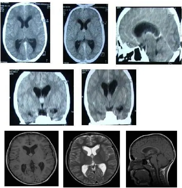 Figure 26 : Kyste colloïde du V3 à la TDM et à l’IRM cérébrale chez un enfant de 10 ans 
