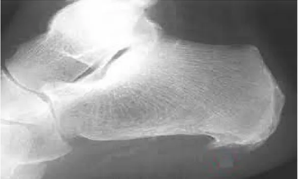 Figure 14 : Radiographie du talon de profil objectivant une épine calcanéenne 