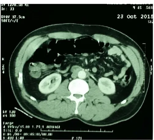 Figure 2 : TDM montrant la plaque de fibrose rétropéritonéale   englobant les deux uretères et les gros vaisseaux 