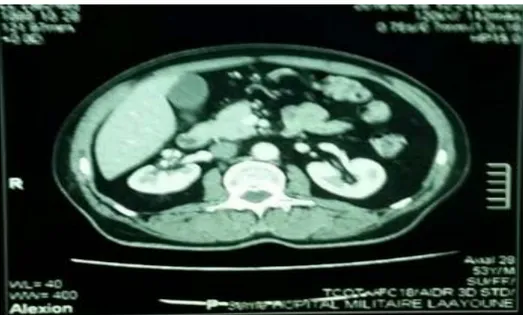 Figure 6 :TDM faite après 3 mois de traitement par corticothérapie montrant une disparition  complète de la plaque de fibrose rétropéritonéale 