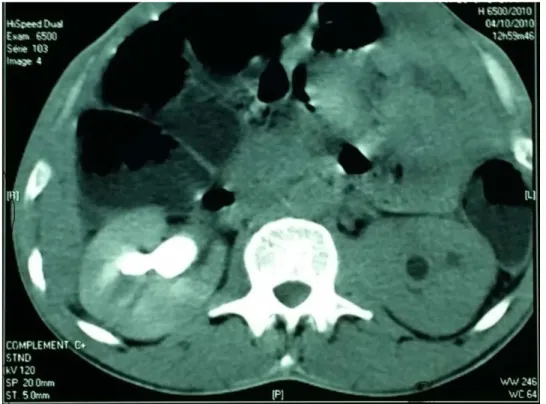 Figure 7 : TDM montrant la plaque de fibrose rétropéritonéale englobant les deux uretères 