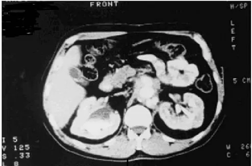 Figure 8 : Uroscanner montrant une plaque de fibrose rétropéritonéale englobant l’aorte,   la VCI et les deux uretères