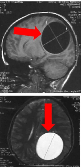 Figure 16: IRM en séquence T1 et T2 en coupes sagittale et axiale: Lésion kystique en hyposignal  T1 et hyper signal T2 bien limitée exerçant un effet de masse sur la ligne médiane et le système 