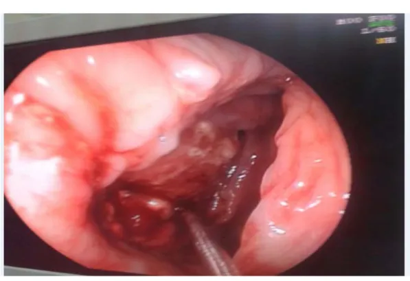 Figure 10: CCR ulcéro-bourgeonnant vue en recto-colonoscopie. 